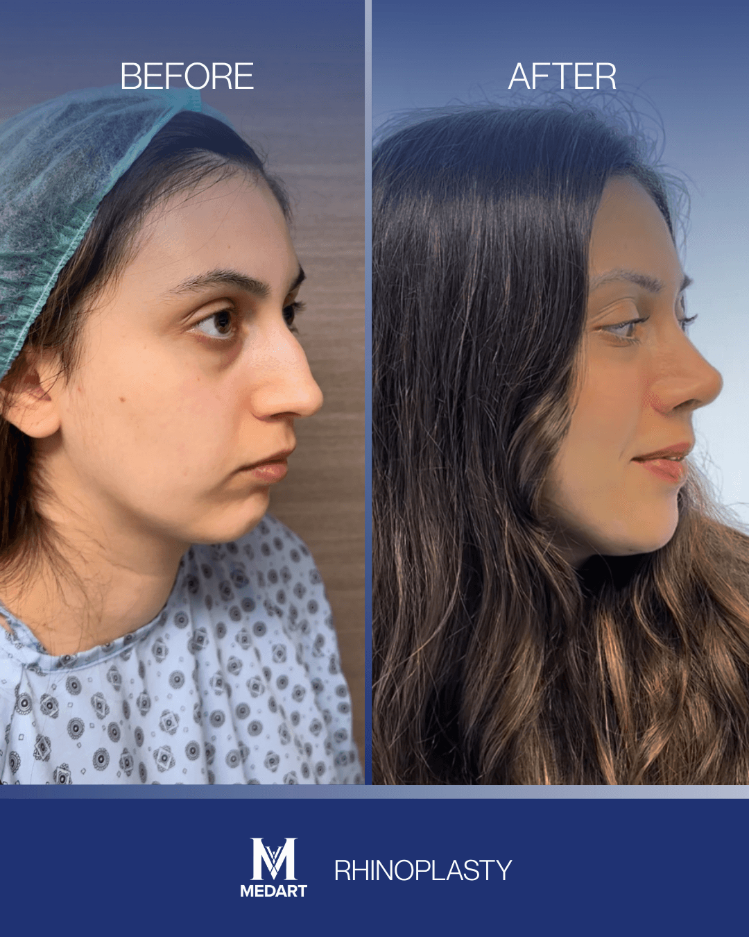 Before After transformation 13