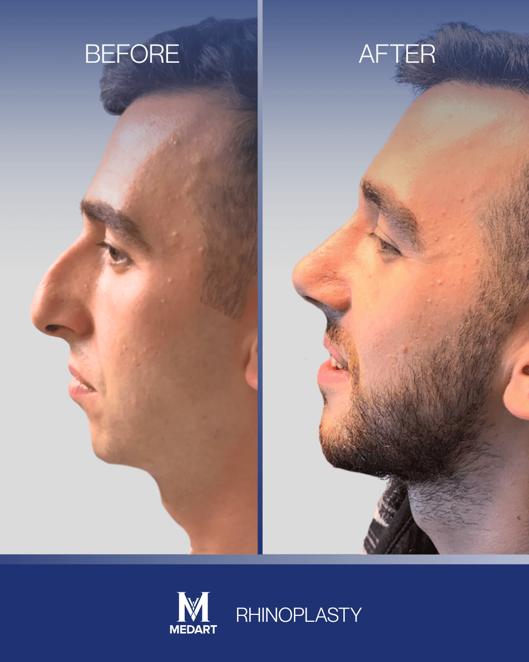 Before After transformation 3